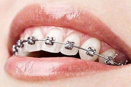 Best Dentist In Aundh Pune