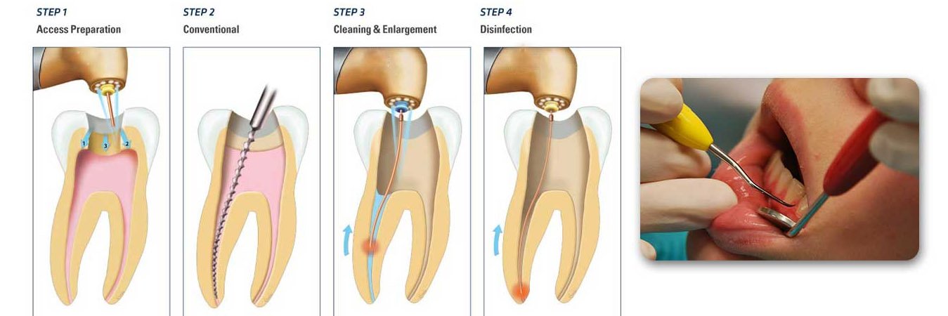 Root Canal Treatment In Aundh Pune