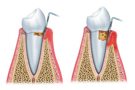 Root Canal Treatment In Aundh Pune